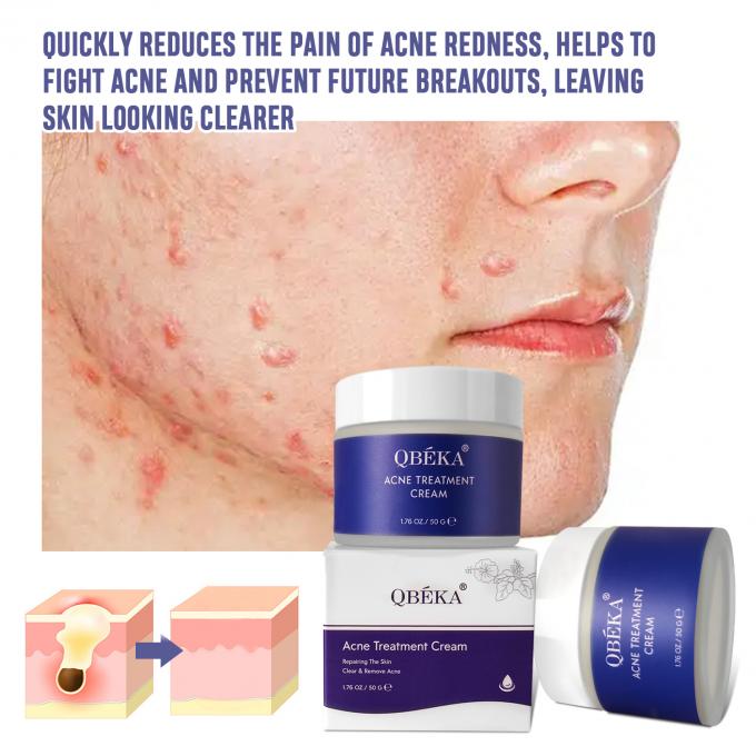 Natürliche Bio-Acne-Behandlung Creme Menge 1000 5
