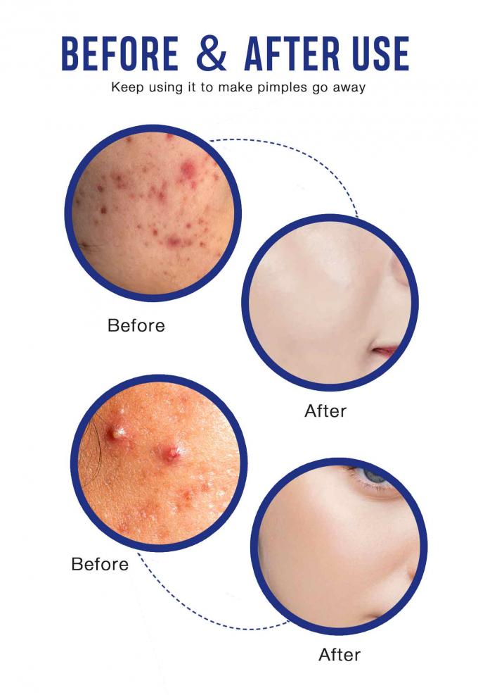 Natürliche Bio-Acne-Behandlung Creme Menge 1000 9