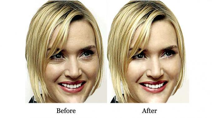 Vorteile von QBEKA Proteinpeptid Serum Wassereinlagerung und Akne Narbenreparatur 10 ml 7